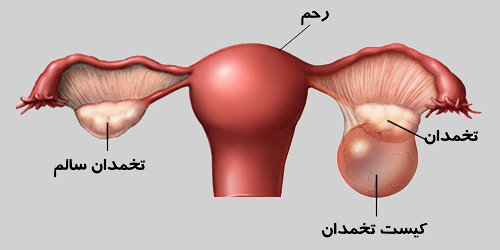 کیست تخمدان- شکل